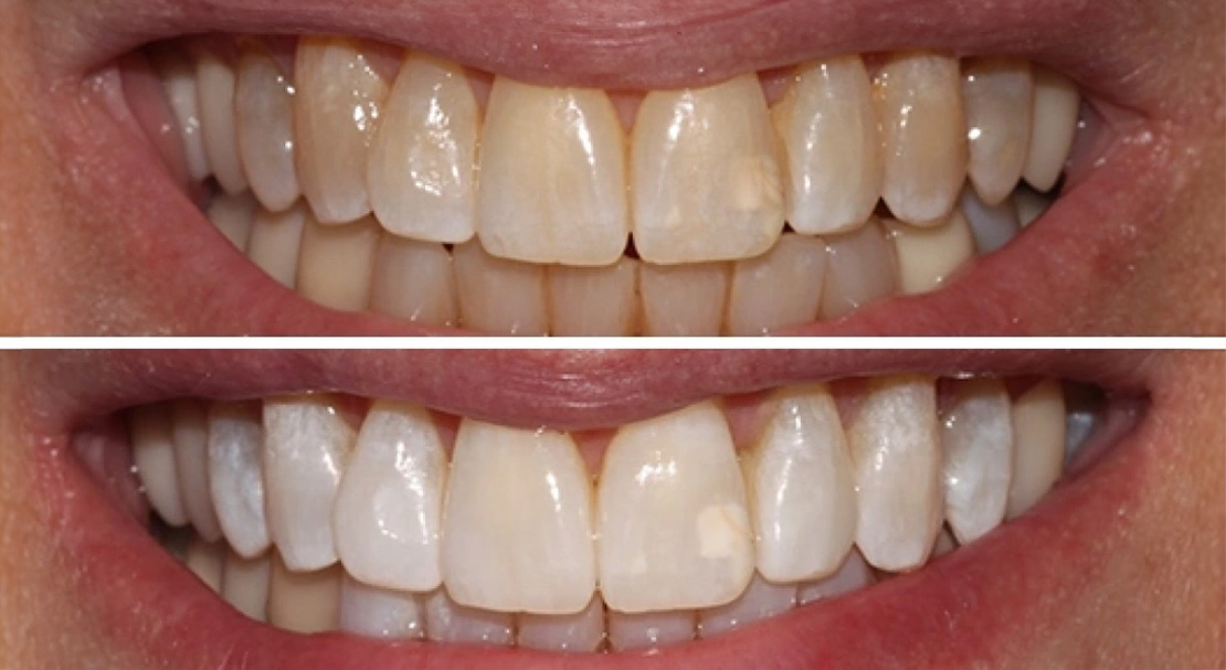 The image shows a person with a big smile revealing yellowed teeth, likely before and after a dental treatment such as teeth whitening, with two contrasting images of their mouth side by side.
