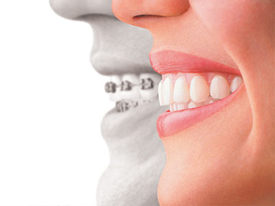 The image shows a side-by-side comparison of a person s natural teeth with a set of dental implants, highlighting the difference between the two.