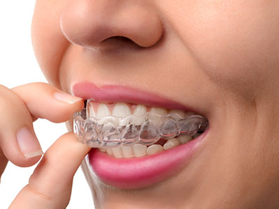 The image shows a person with a mouth full of clear braces, looking directly at the camera, with their hand holding up their chin.