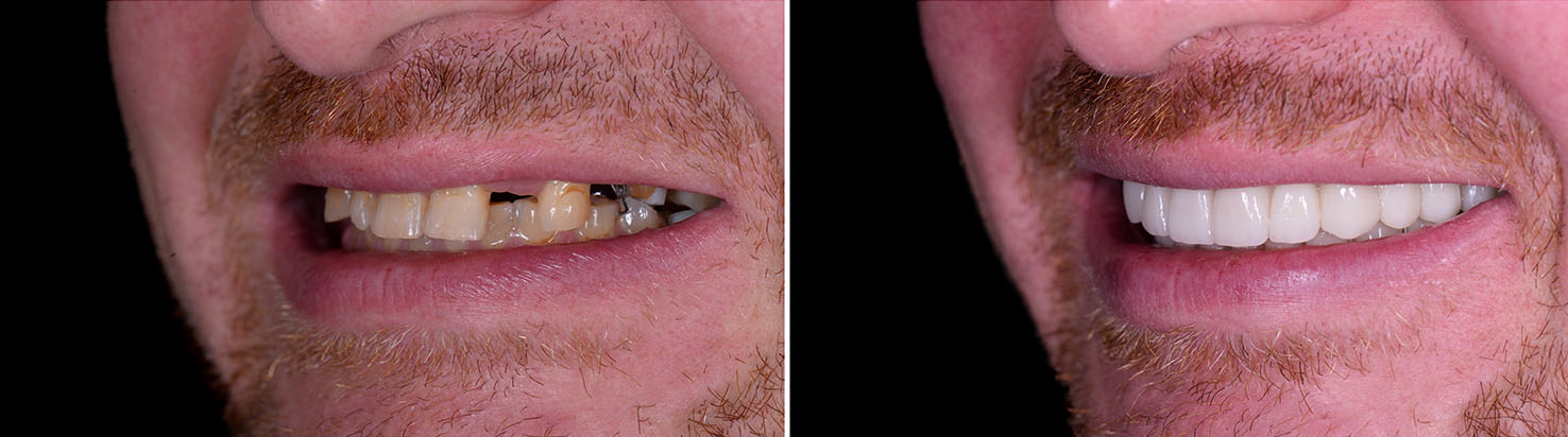 The image displays two photographs placed side by side. On the left, there s an individual with a wide smile showing teeth, and on the right, the same person appears with their mouth open, revealing a missing tooth.