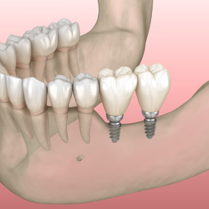 Who Needs Mini Dental Implants?
