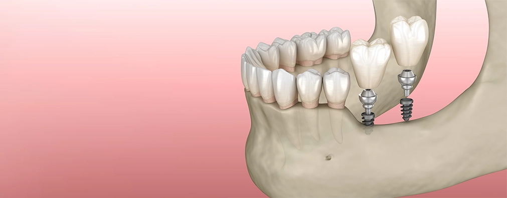 Image of Mini Dental Implant