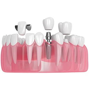 dental Implants